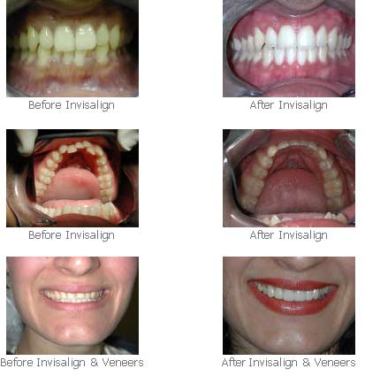 All About Invisalign in El Monte CA - Atlas Dental Care and Orthodontics